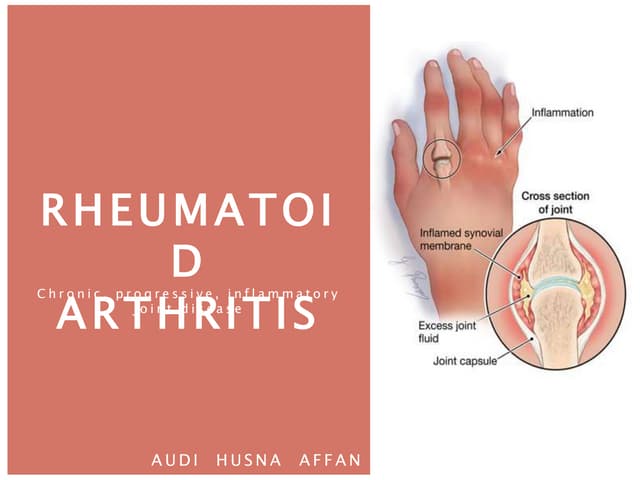 Rheumatoid Arthritis