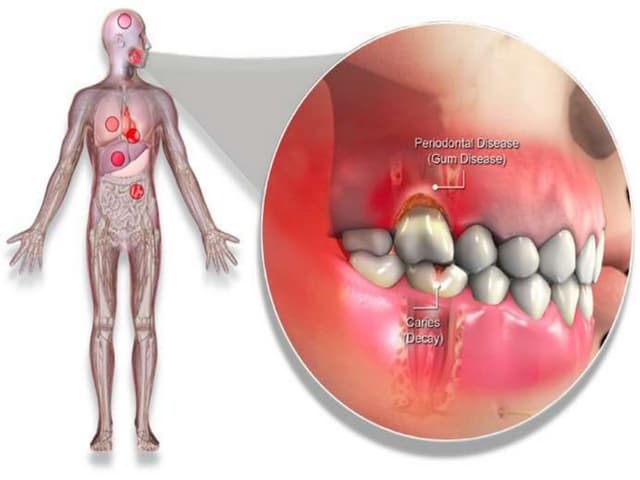 Periodontitis as a risk factor for systemic diseases