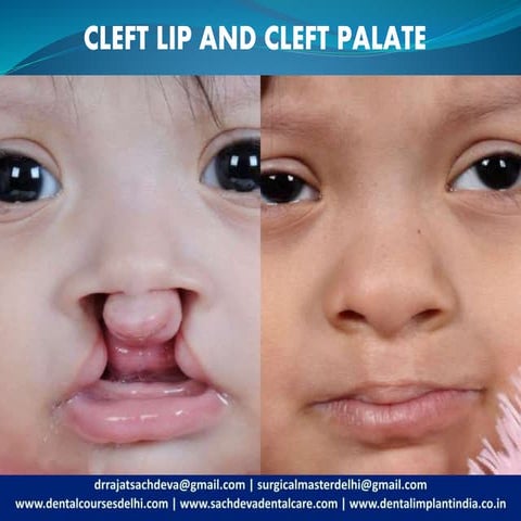 Cleft lip/Cleft Palate |  Cleft Lip, Cleft Palate: What is a cleft lip, cleft...