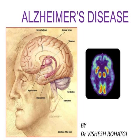 Alzheimer disease