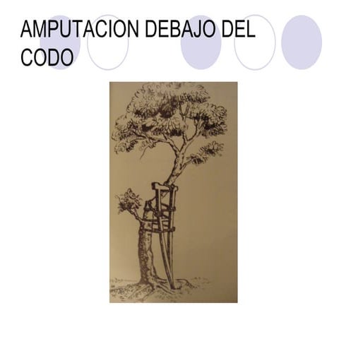 Amputacion debajo del codo
