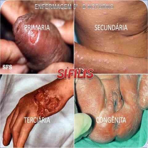 Apresentação Sífilis 2010 TURMA ENFERMAGEM 5º SEMESTRE UNIÍTALO