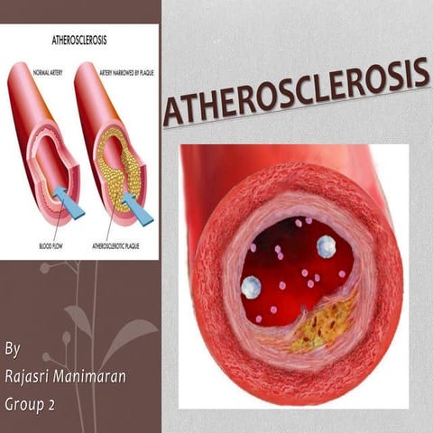 Atherosclerosis