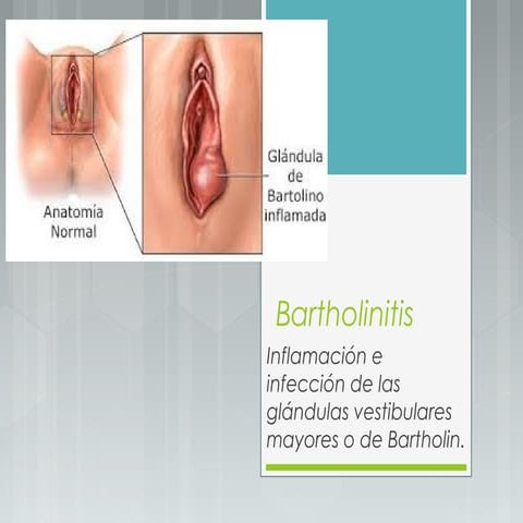 Bartholinitis