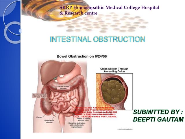 intestinal obstruction