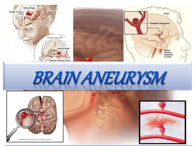 Brain aneurysm