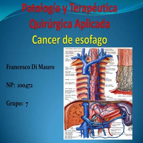 Cáncer de esófago