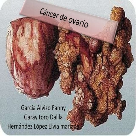Clace De Ca Ovario 2