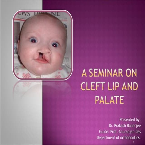 CLEFT LIP AND PALATE - etiology and managemnt