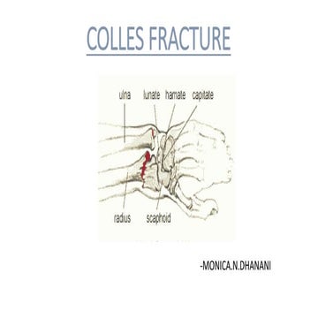 Colles fracture