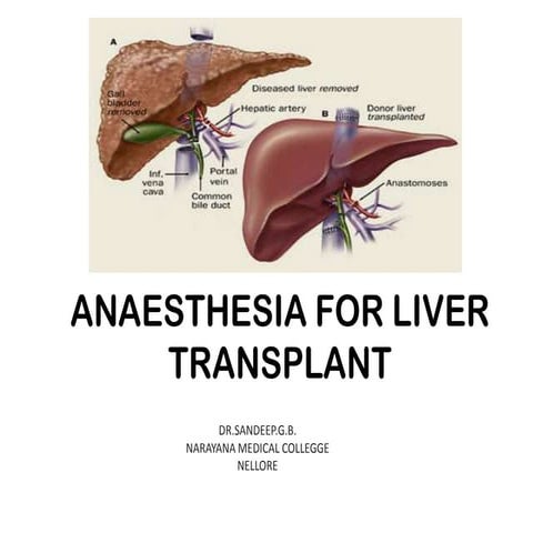 Liver Transplantation 