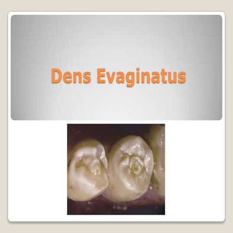Dens evaginatus