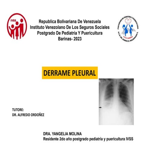 DERRAME PLEURAl en pediatría generalidades