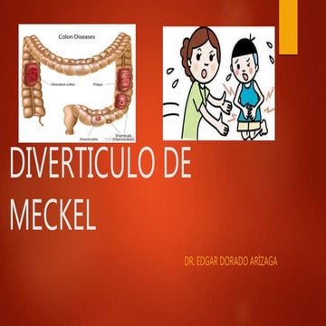 Diverticulos de meckel