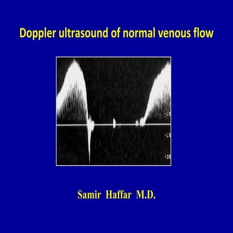 Doppler ultrasound of normal venous flow