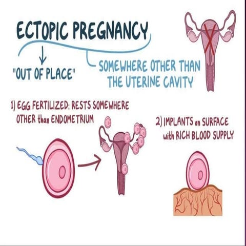 Ectopic pregnancy