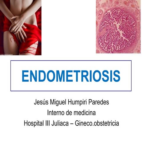 Endometriosis - manejo clinico