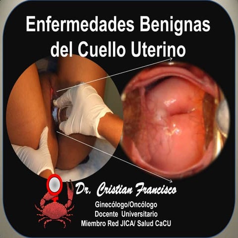 Enfermedades Benignas del Cuello Uterino Oct  2013