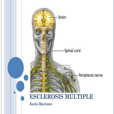 Esclerosis múltiple