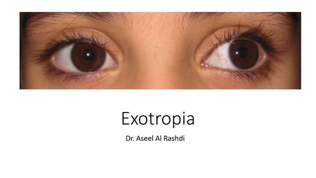 Exotropia 