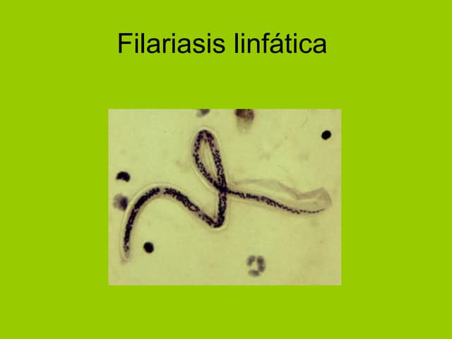 Filariasis linfática