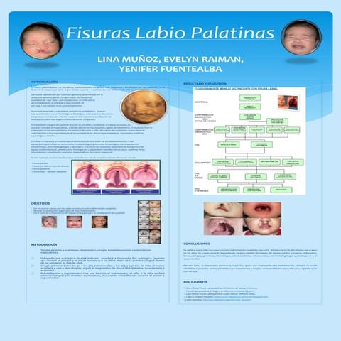 Fisura labiopalatina