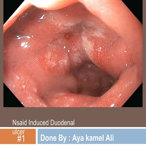 Formal case Presentation (care plan for  patient has duodenal ulcer caused by...