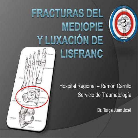 Fracturas del mediopie y luxofractura de Lisfranc