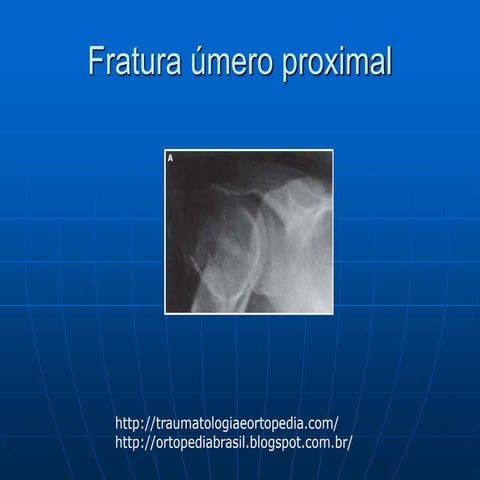 Fratura umero proximal