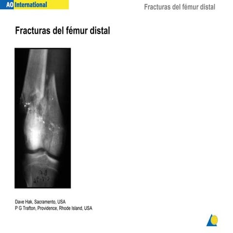 Fx femur distal