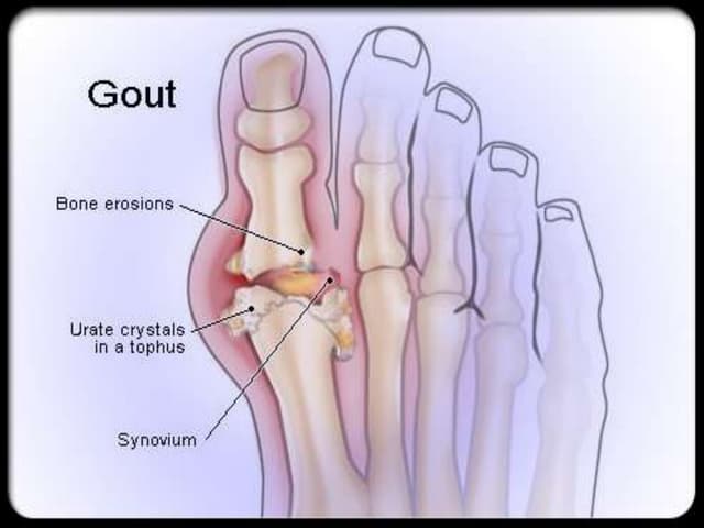 Gout