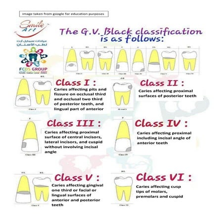 Gv black classification of caries