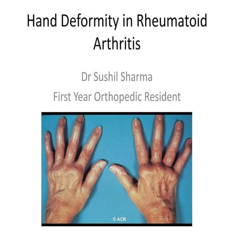 Hand deformity in rheumatoid arthritis