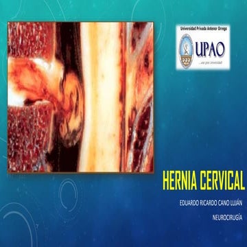 Hernia cervical Neurocirugia
