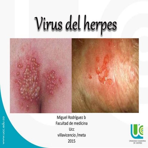 Herpes 