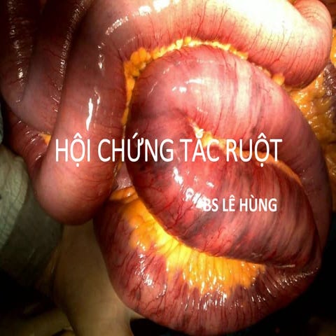 Hội chứng tắc ruột