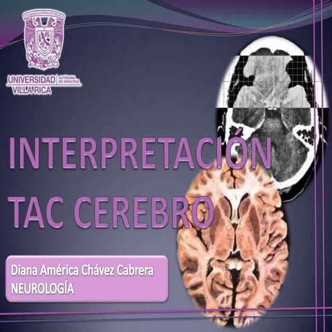INTERPRETACION DE ANATOMIA CEREBRAL EN UNA TAC CRANEAL
