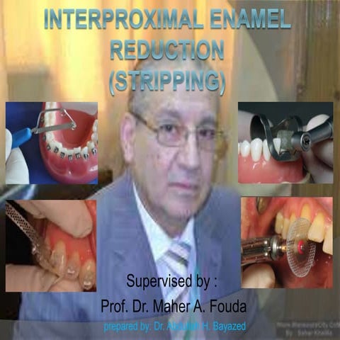 Interproximal Enamel Reduction (stripping)