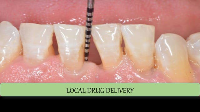 local drug delivery in periodontics