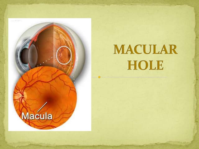 Macular   hole