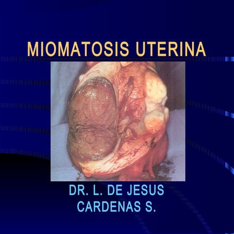 Miomatosis uterina