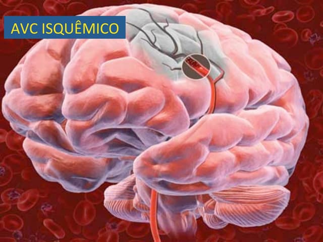 Neurorradiologia AVC isquêmico e hemorrágico