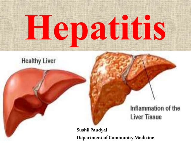 Hepatitis B (Nepal senario) 