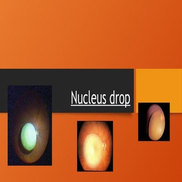 Complications of cataract surgery - Nucleus drop