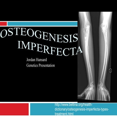 Osteogenesis imperfecta