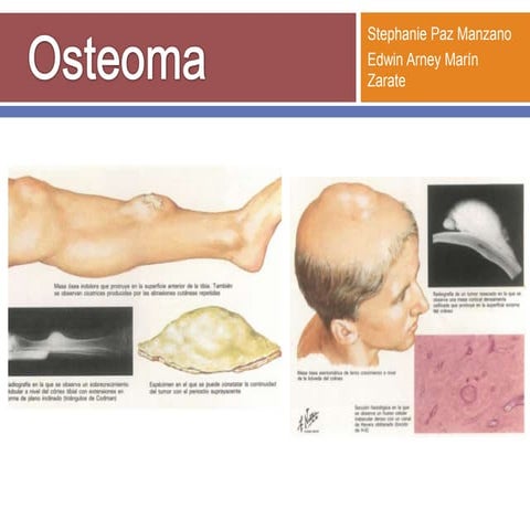 Osteoma