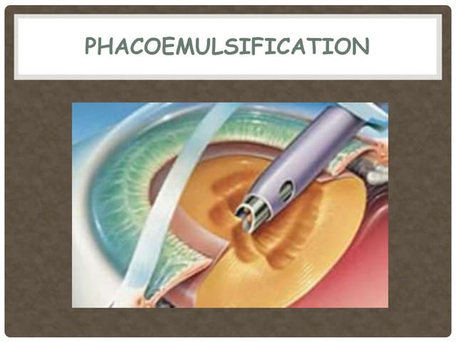 Phacoemulsification