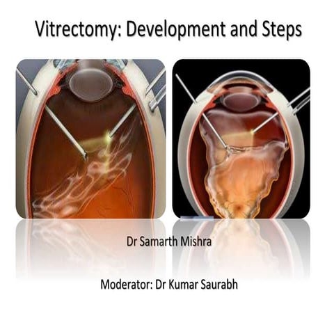 Vitrectomy: Development And Steps