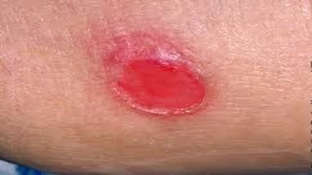 PRESSURE SORE.pptx Ms. Shweta Singh.......