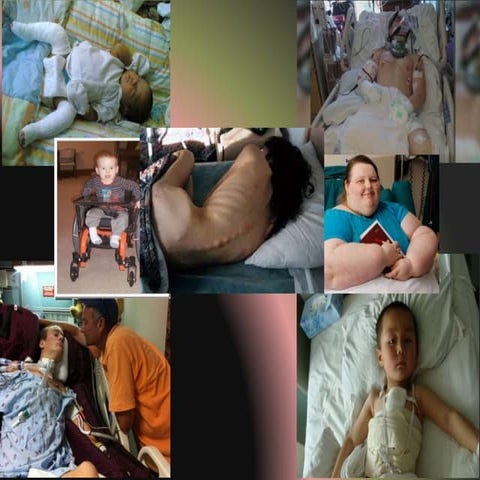 Pressure ulcer prevention[2]